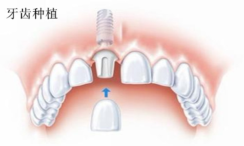 种植牙修复牙齿缺失好不好呢