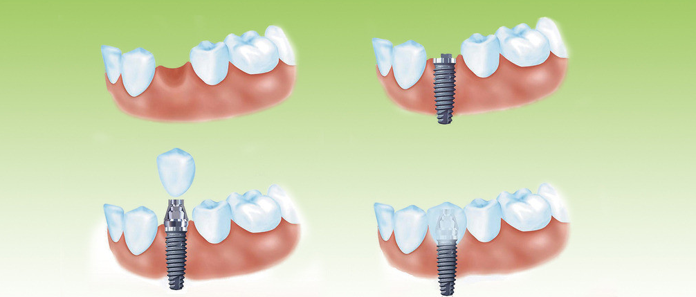 门牙掉了还能再长吗