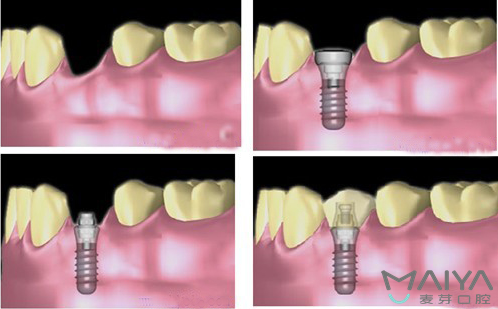 深圳种植牙手术多少钱？