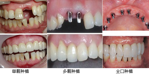 门牙种植的价格是多少?