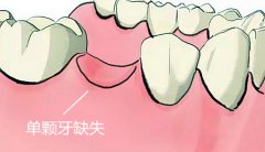 深圳固定义齿修复是怎么做的