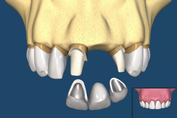 年龄大了还能做种植牙吗?