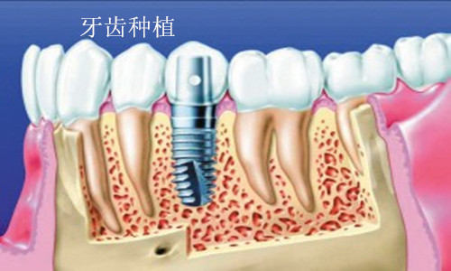 拔牙后怎样补牙才会比较好