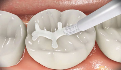 儿童做窝沟封闭