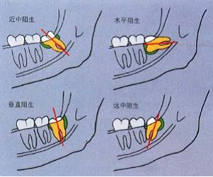 智齿问题怎么解决