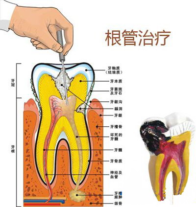 根尖炎做根管治疗收多少钱
