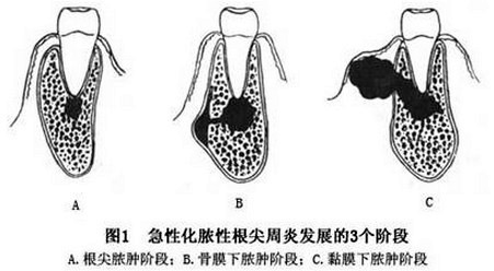 根尖脓肿