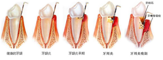 牙周炎.jpg